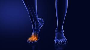 What Is Neuropathy? Symptoms, Causes, and Treatment Explained